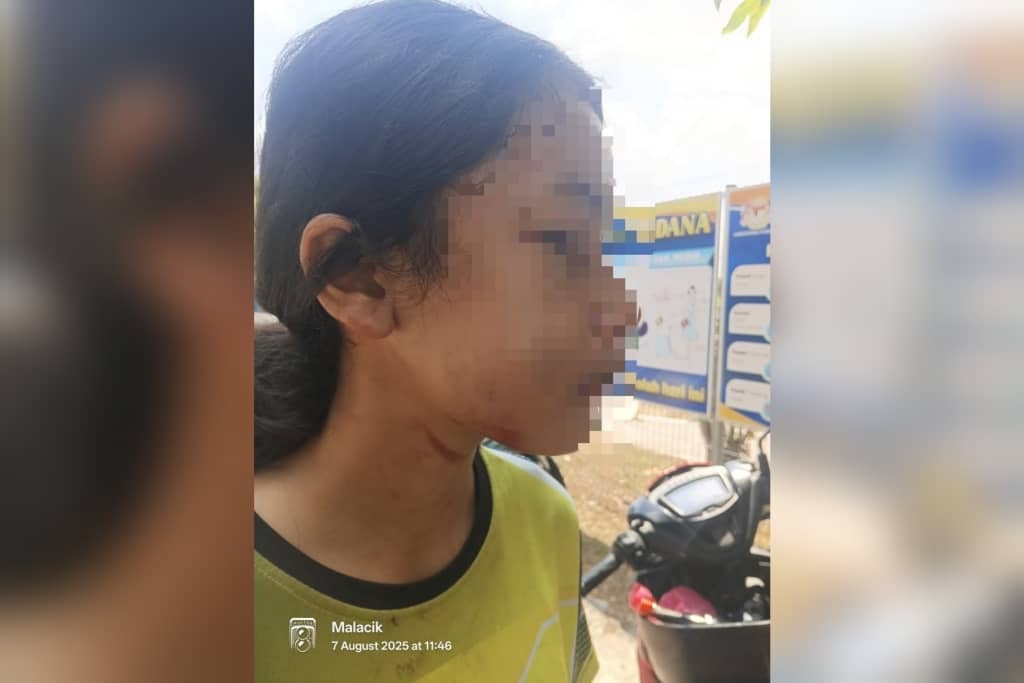 கொள்ளையனின் தாக்குதலில் 12 வயது சிறுமி காயம்